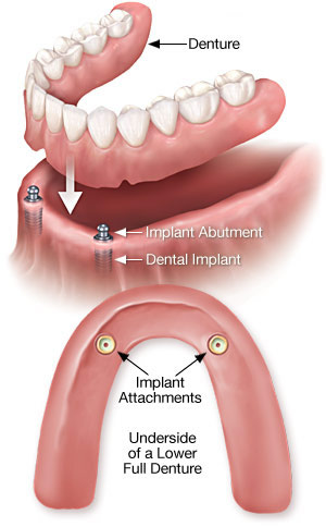 Dental Implants Over Denture - Tyler, TX: Dr. Steven M O'Neal DDS