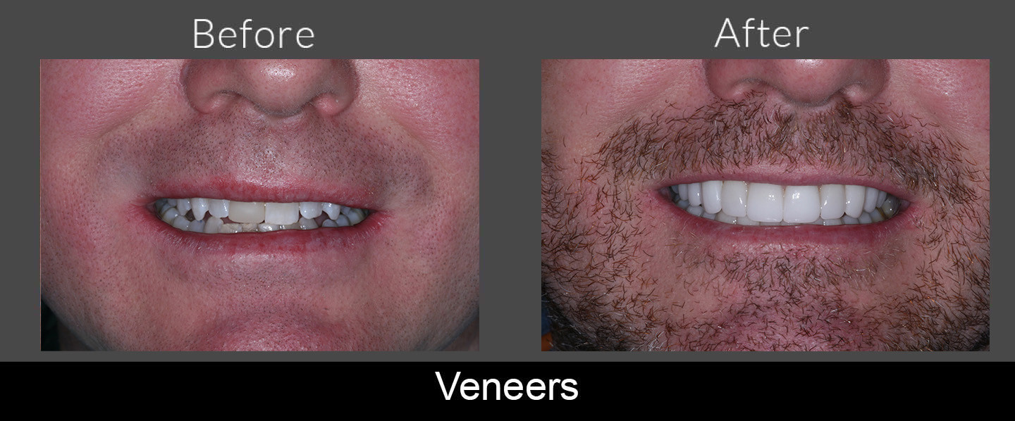 Before and After SureSmile and Minimal Prep Veneers