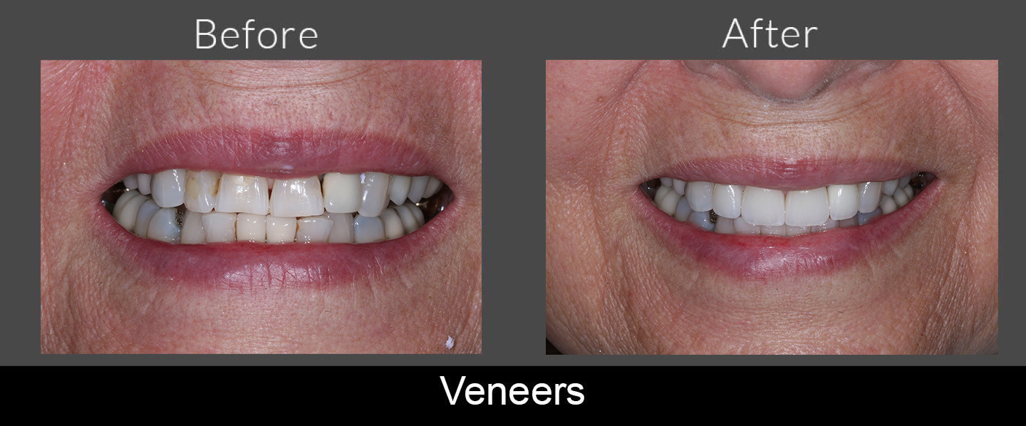 Before and After Crowns and Veneers